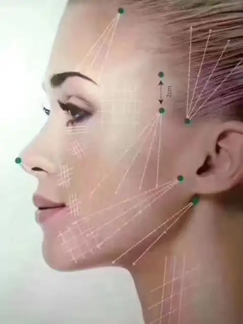 面部线雕提升是什么?线雕有什么作用?