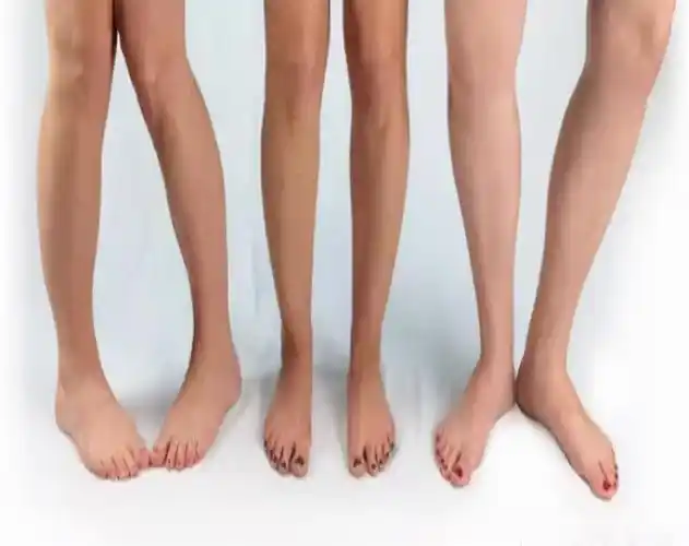 外八字孩子脚型正常不正常