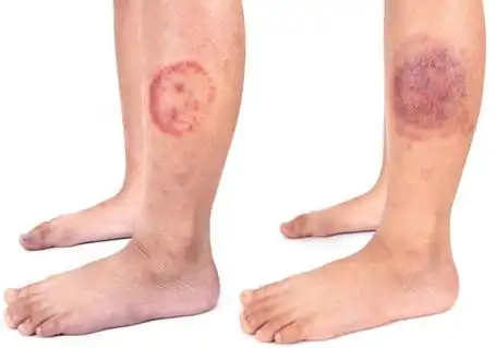 如何区分湿疹和癣的区别附对比图片