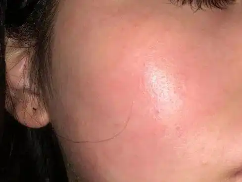 皮肤屏障受损怎么修复?快来抄作业!