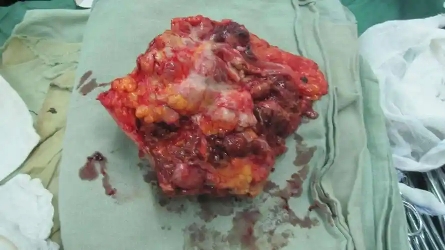 图片左大腿横纹肌肉瘤手术切除一例