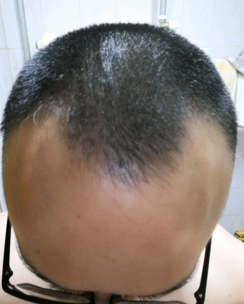 20岁小伙才读了2年编程,就出现m型发际线,担心没毕业就秃了