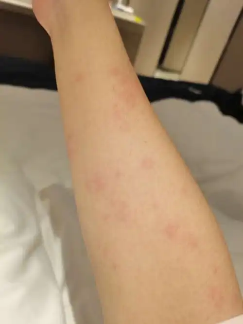 过敏性荨麻疹中药西药治疗效果都不怎么样,该怎么办