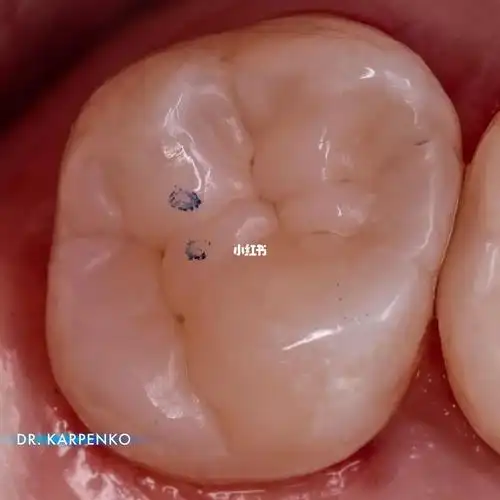 上颌第一磨牙树脂修复