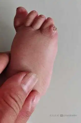 邯郸一幼儿小脚趾畸形,医生手术失误致截肢