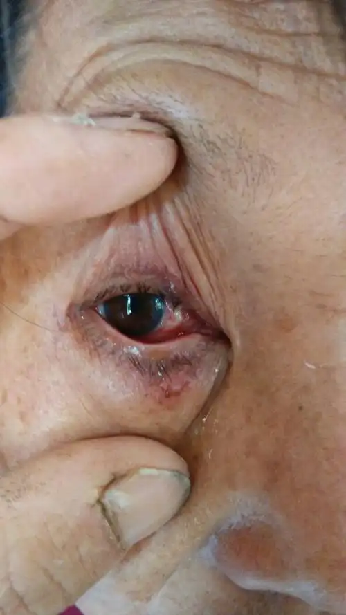 眼镜转动时有磨痛感,流眼泪,白眼珠有个白色肉疙瘩东西,眼皮浮肿,到