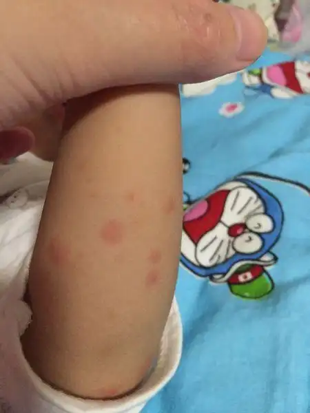 九个月宝宝两只手臂起红疹去医院查说是过敏,配了糠酸莫米松乳膏和