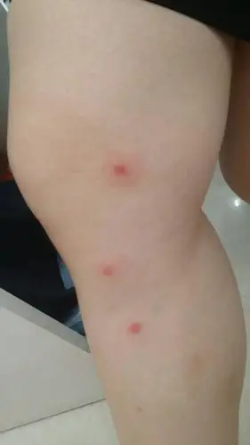 每年这个时候身上都会长出一些红色的疙瘩,很痒,过一