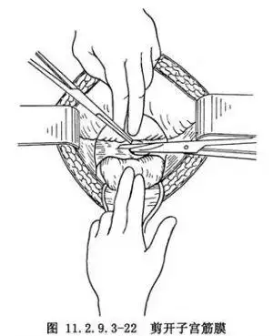 腹膜外剖宫产术