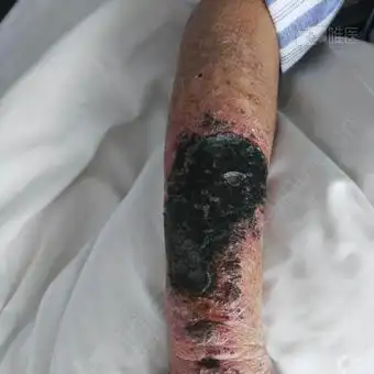 男,前臂大面积皮肤坏死