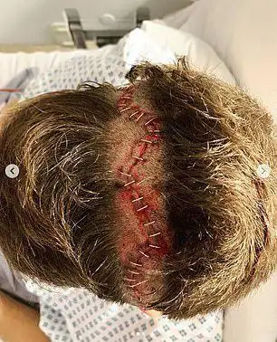 恐怖曲棍球手被球击中失明切开脑袋手术满头刀疤