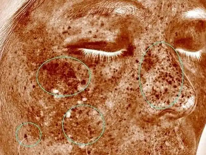 "黄褐斑是一种面部获得性色素增加性皮肤病,多发生于频繁暴露于紫外线