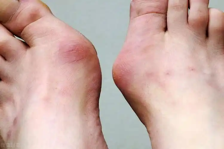大脚趾偏斜骨头凸出,这种情况要不要治?要看有没有这两个特征