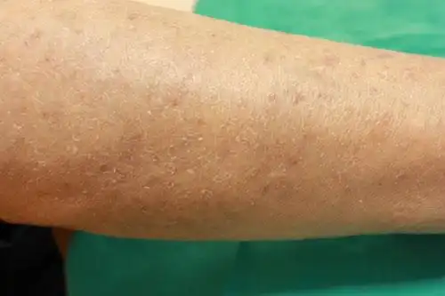 尿毒症的症状  皮肤无华,干燥脱屑,瘙痒是尿毒症患者常见的症状,皮肤