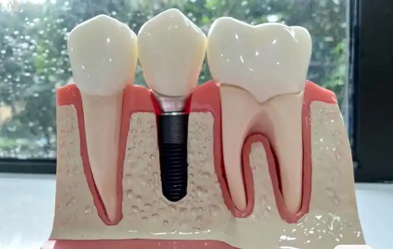 为什么西安美奥冯雪教授,建议大家选择种植牙?_荔枝美