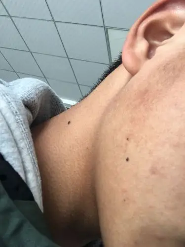 我脸上两侧颚骨各有一个痣?寓意着什么?