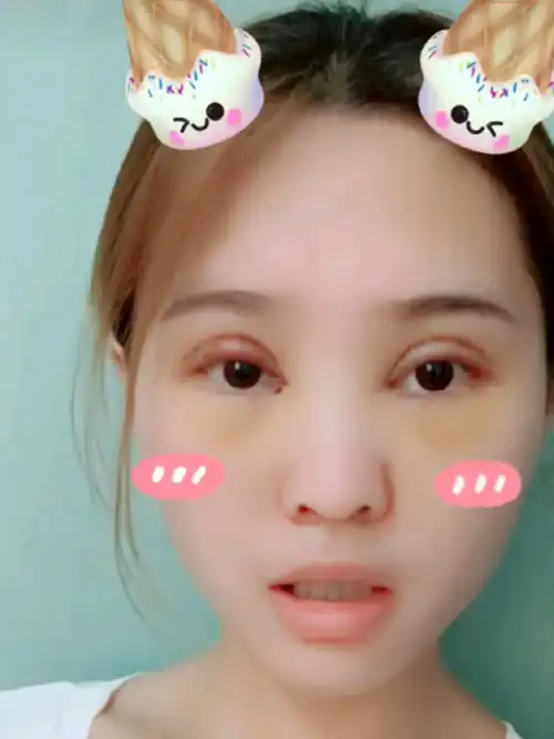 美女做个双眼皮,前期恢复有点恐怖,但50天后,效果有点