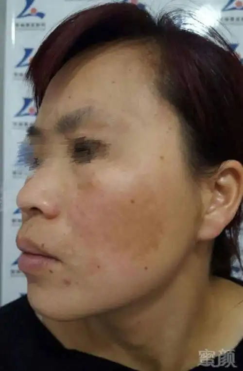 纳晶导入药物治疗黄褐斑的效果到底有多好呢?