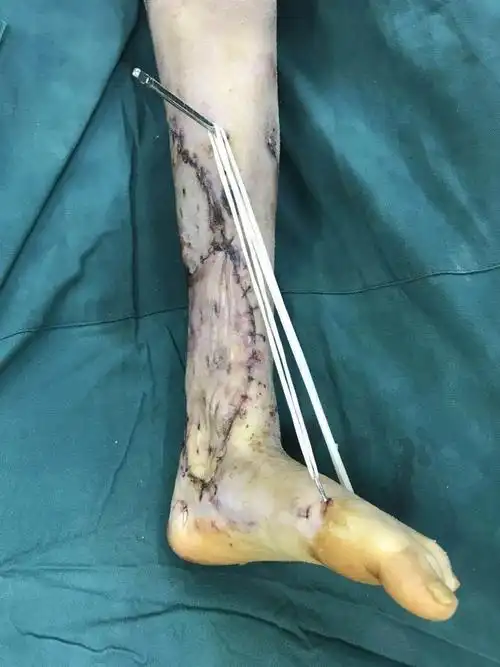 女子遭遇车祸险些截肢手术后出现奇迹