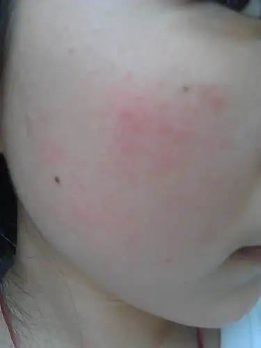 皮肤过敏之后,还有在怀疑是红血丝还是过敏没好.