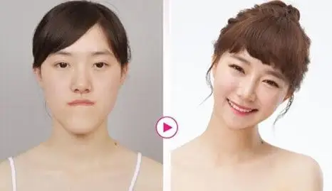 韩国下巴突出怎么矫正