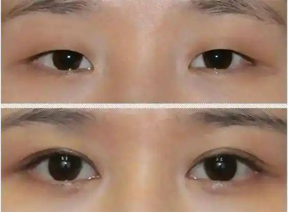 割双眼皮 开眼角,术后恢复对比图分享,看看吧