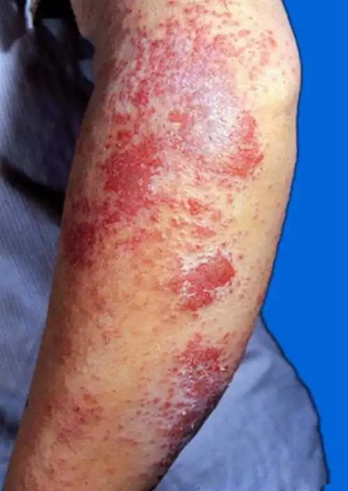 湿疹图片