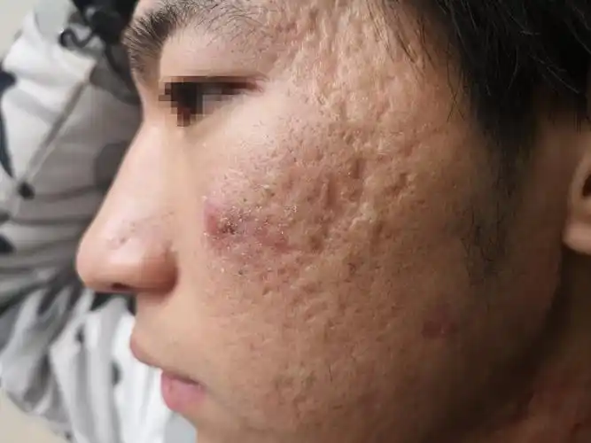 聚合性痤疮痘坑