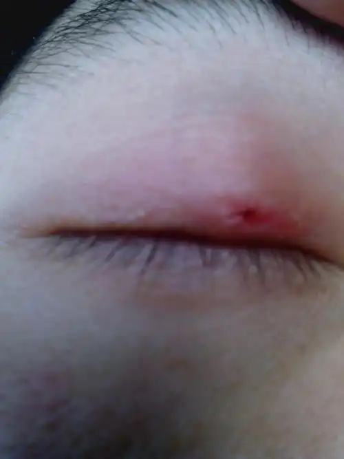 您好,我也是麦粒肿四个月,其中用药热敷一个月.