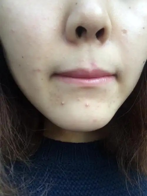 火疖子高清图片_有来医生