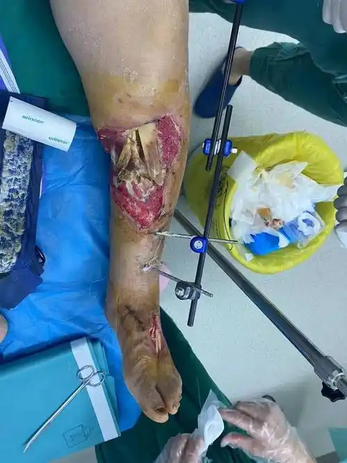 截肢?不可能!骨科这样保住了宋阿姨的腿