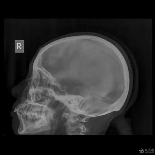 头颅x片 ~ 额骨高密度影