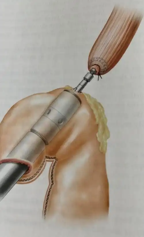 食管和管胃颈部吻合示意图 - 好大夫在线