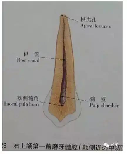 与尖牙形态类似,但髓室,根管较窄近远中剖面:上颌第一前磨牙的髓腔