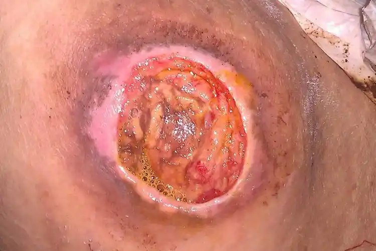 皮肤发生褥疮后应加强皮肤护理,及时清除伤口坏死组织,配合抗感染治疗