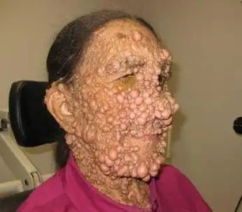 1型神经纤维瘤病药物阿斯利康激酶抑制剂koselugoselumetinib获美国