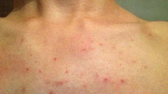 医生 皮肤这1变化,千万别大意女子身上长红点,确诊为肝癌晚期,医生