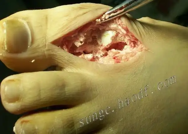 远离痛风 ,可怕的痛风石--附手术图片 - 好大夫在线