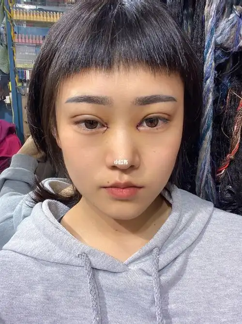 双眼皮 开眼角 第四天_开眼角_双眼皮_埋线双眼皮_美妆_医美整形