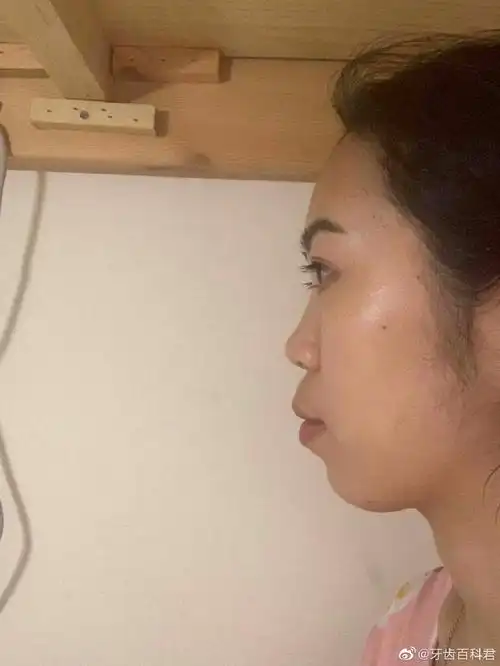 我之前的牙齿,深覆合龅牙,然后还有牙齿不齐,侧面嘴突,牙齿正畸完成后