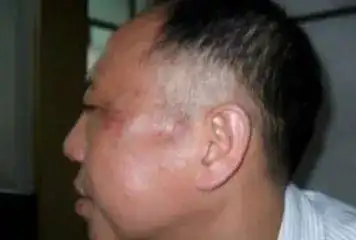 其他部位出现浮肿则要重视,例如脸形出现肿胀,脸部肌肉组织松弛,用