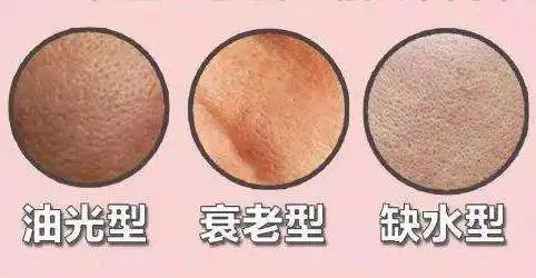 不同类型毛孔粗大