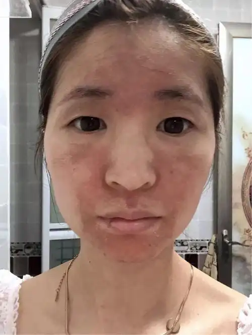 面部湿疹治疗全过程
