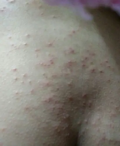 怀孕五个月患有毛囊炎,可以用白醋搽洗患处或则洗澡吗?