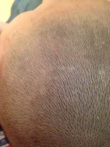 五岁男童,头上象是白癣症状