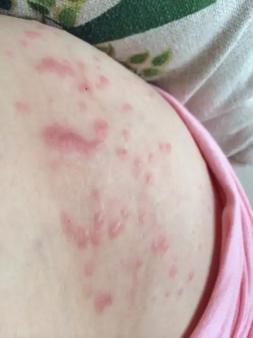 有没有人孕晚期像我这样皮肤痒起胗子图片恐怖慎入