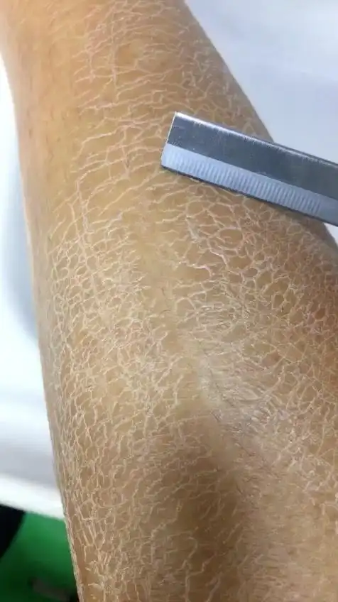 我来啦,解决鸡皮 蛇皮 妊辰纹皮肤干燥粗糙 @经纪人小微