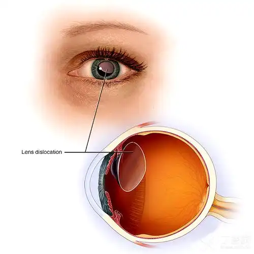 儿童马凡综合征双眼晶状体半脱位 [病例帖]