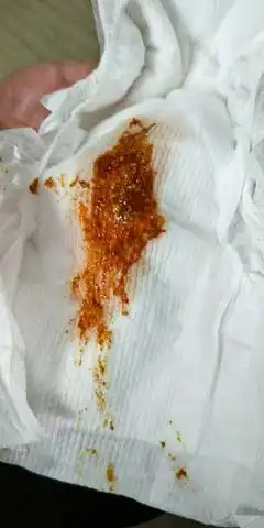 有图慎入!大便带血,有人知道怎麼回事吗