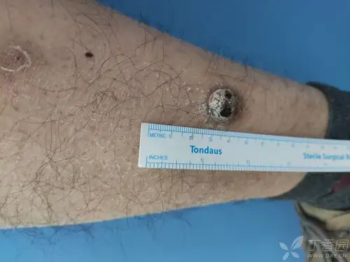 右小腿屈侧肿物1年余 [病例帖]